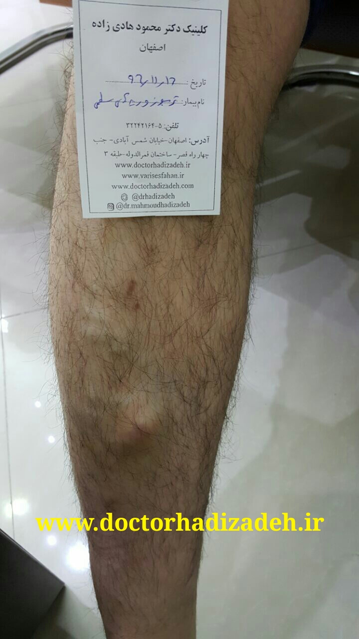 بهترین متخصص درمان واریس در اصفهان