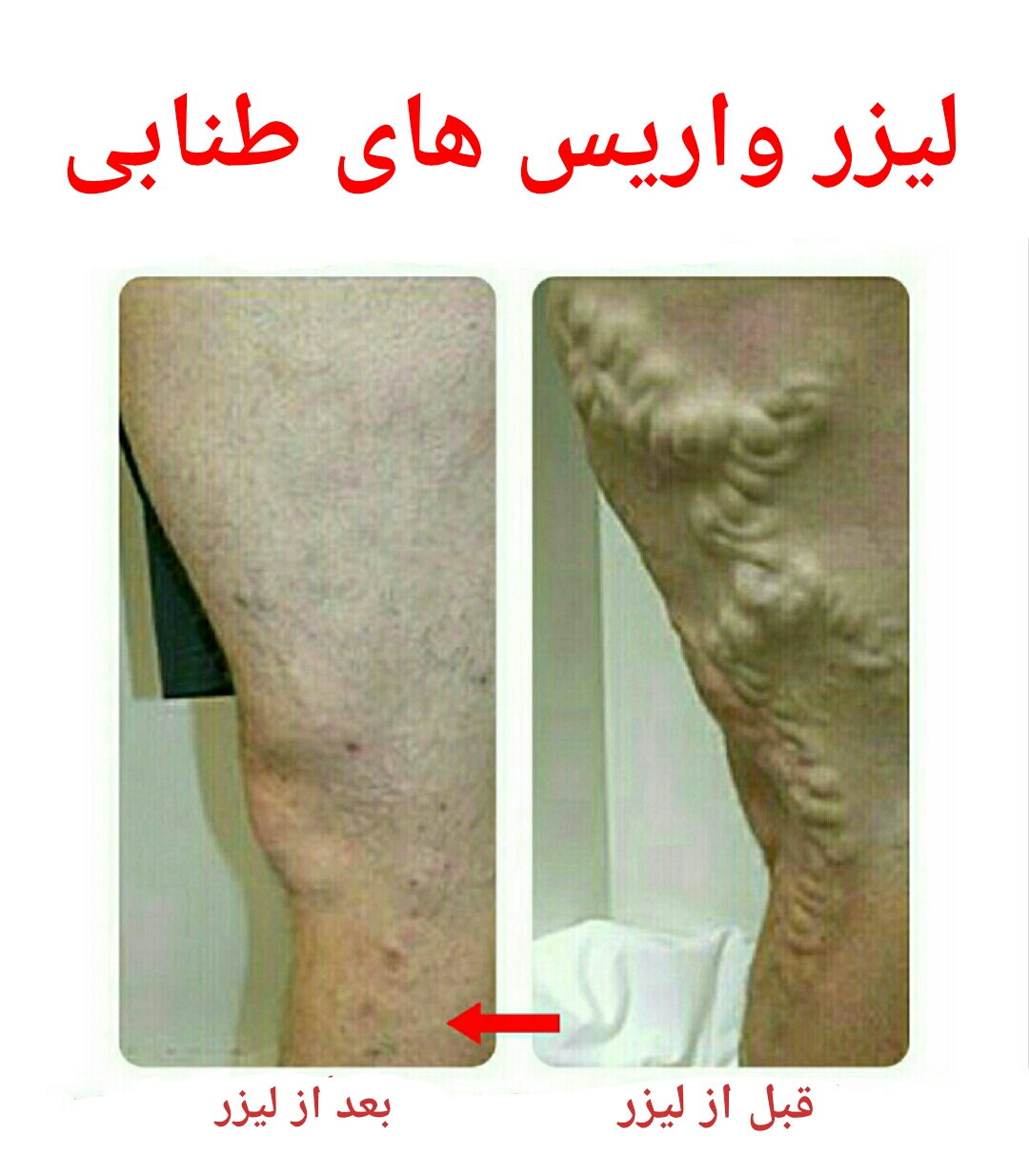 درمان واریس در اصفهان
